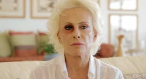 Ana Maria Braga aparece de olho roxo no ‘Mais Você’ e gera polêmica